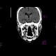 Skull fissure, epidural hematoma: CT - Computed tomography